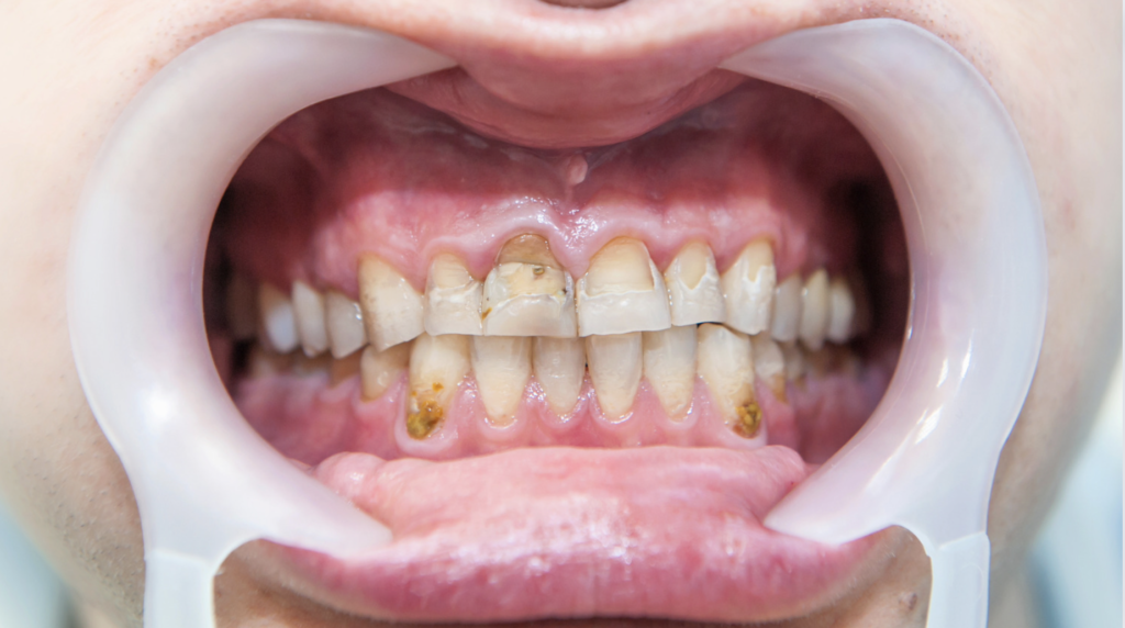 dental fluorosis water distiller